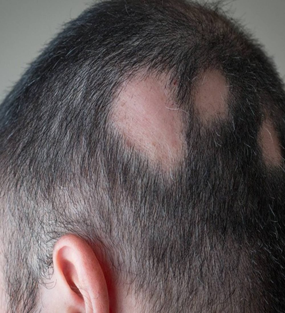 thumbnail-alopecia-areata