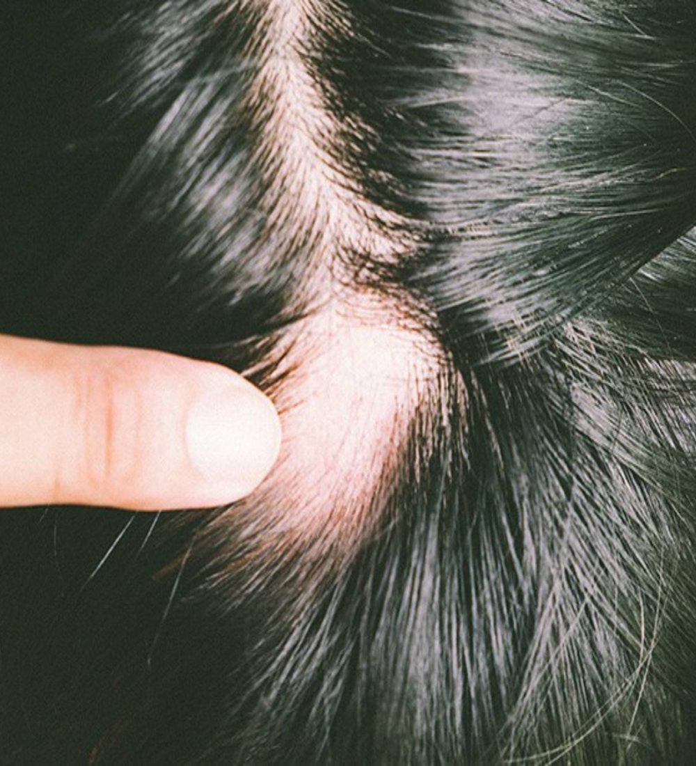 thumbnail-alopecia-cicatricial