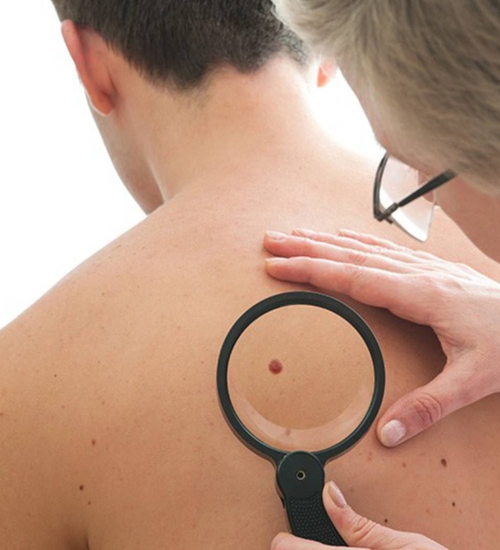 thumbnail-cancer-de-pele