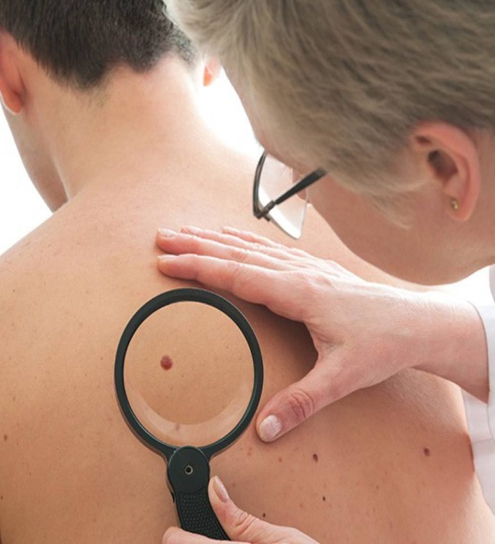 thumbnail-cancer-de-pele