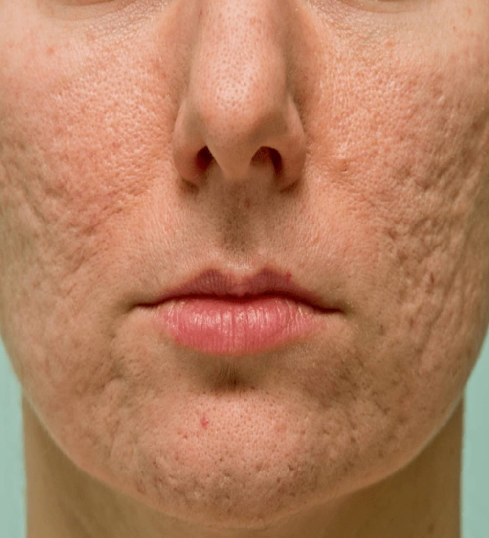 thumbnail-cicatriz-acne