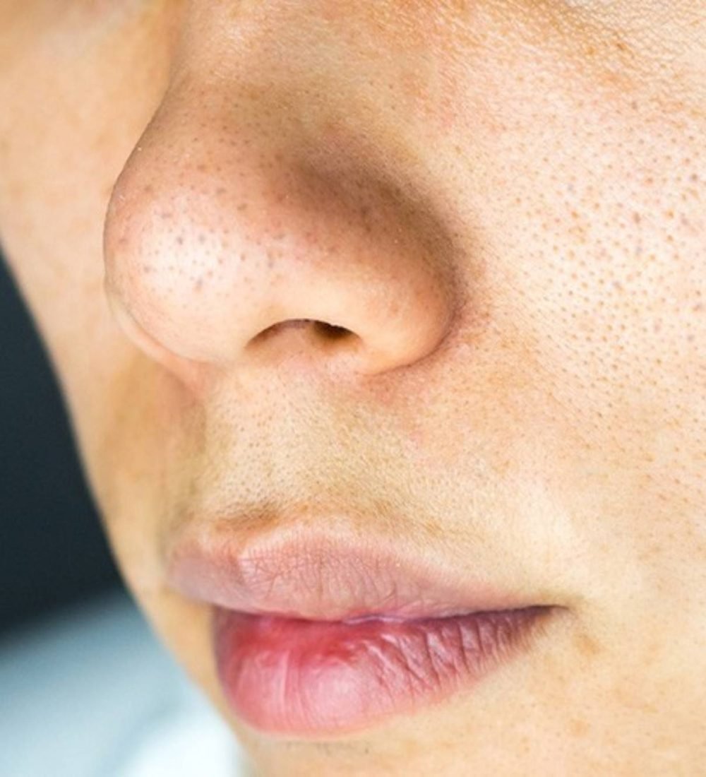 thumbnail-cicatriz-de-acne