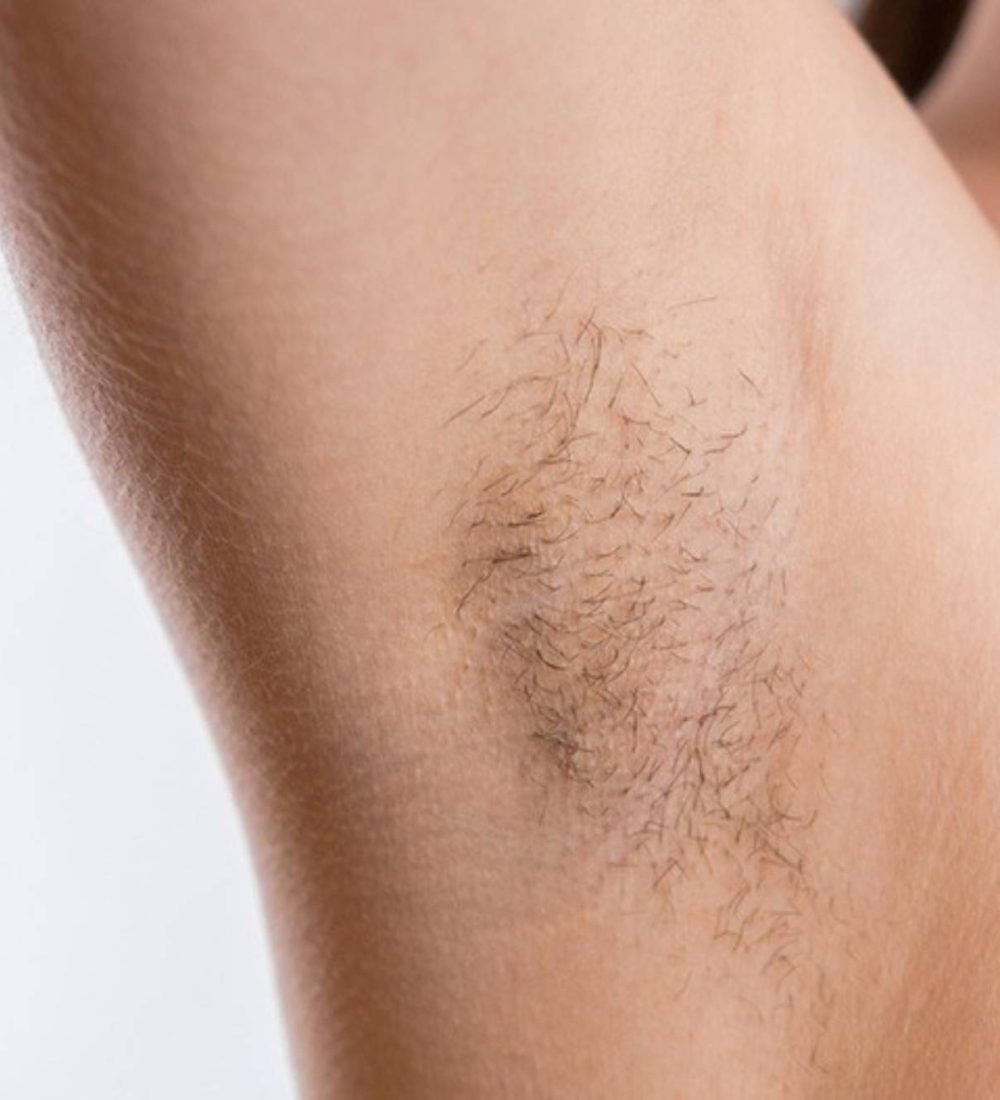 thumbnail-foliculite