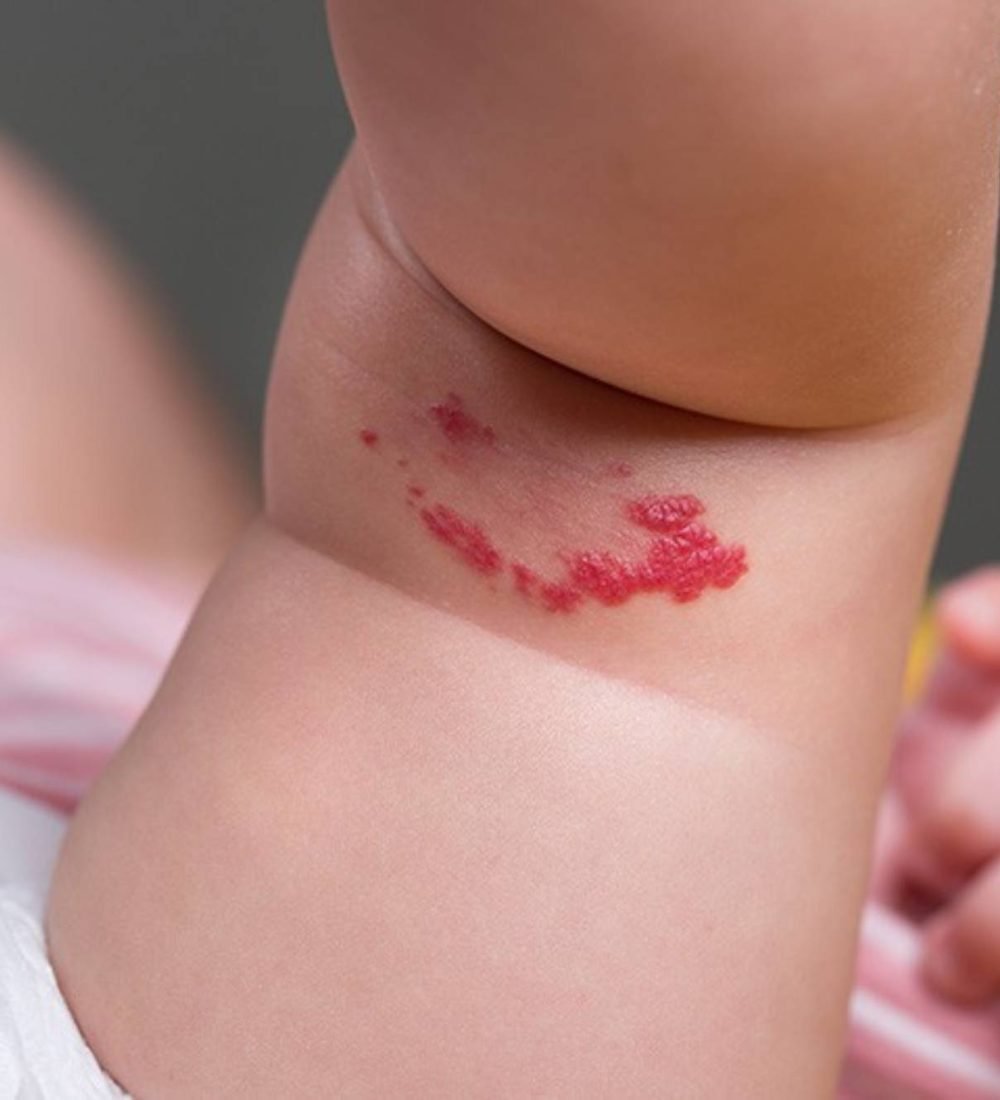 thumbnail-hemangioma