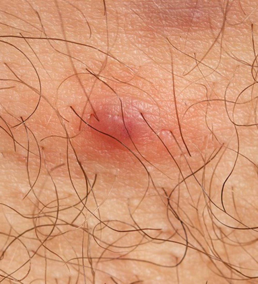 thumbnail-hidradenite