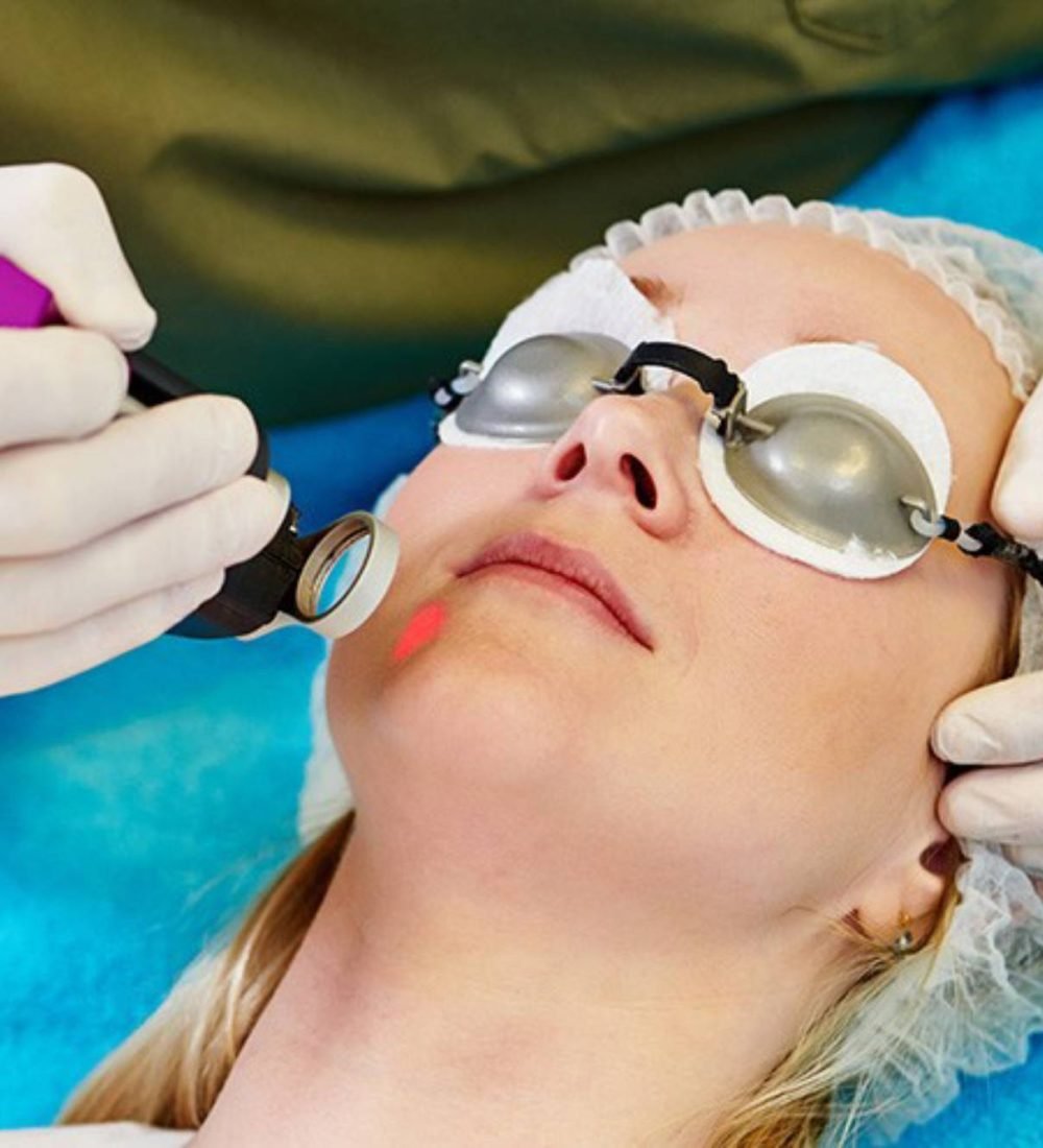 thumbnail-laser-para-melasma