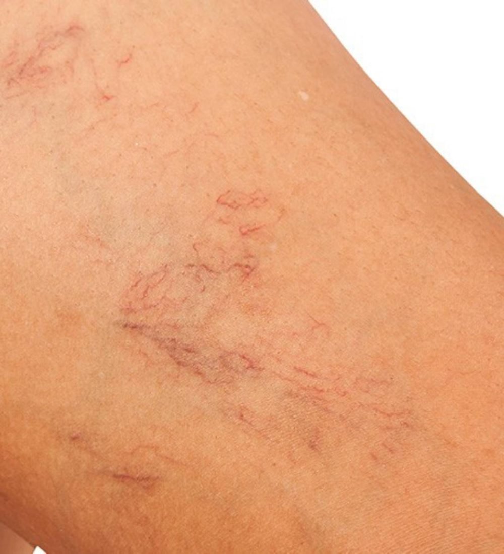 thumbnail-laser-para-vasinhos