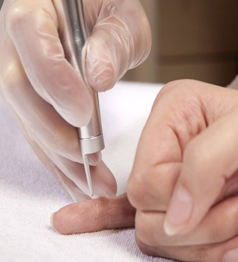 thumbnail-remocao-de-cistos