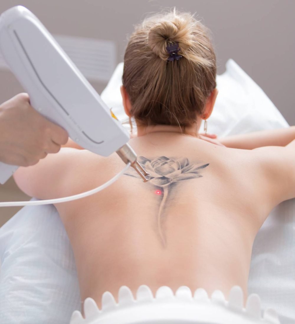 thumbnail-remocao-de-tatuagem