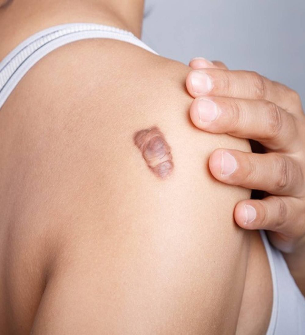 thumbnail-tratamento-de-queloide